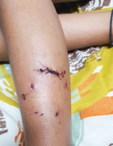 Pack of stray dogs attack family in Aquem; injure 3-year-old boy