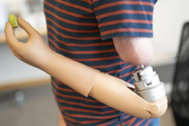 25 PwDs to get latest brain controlled myoelectric  hands free of cost