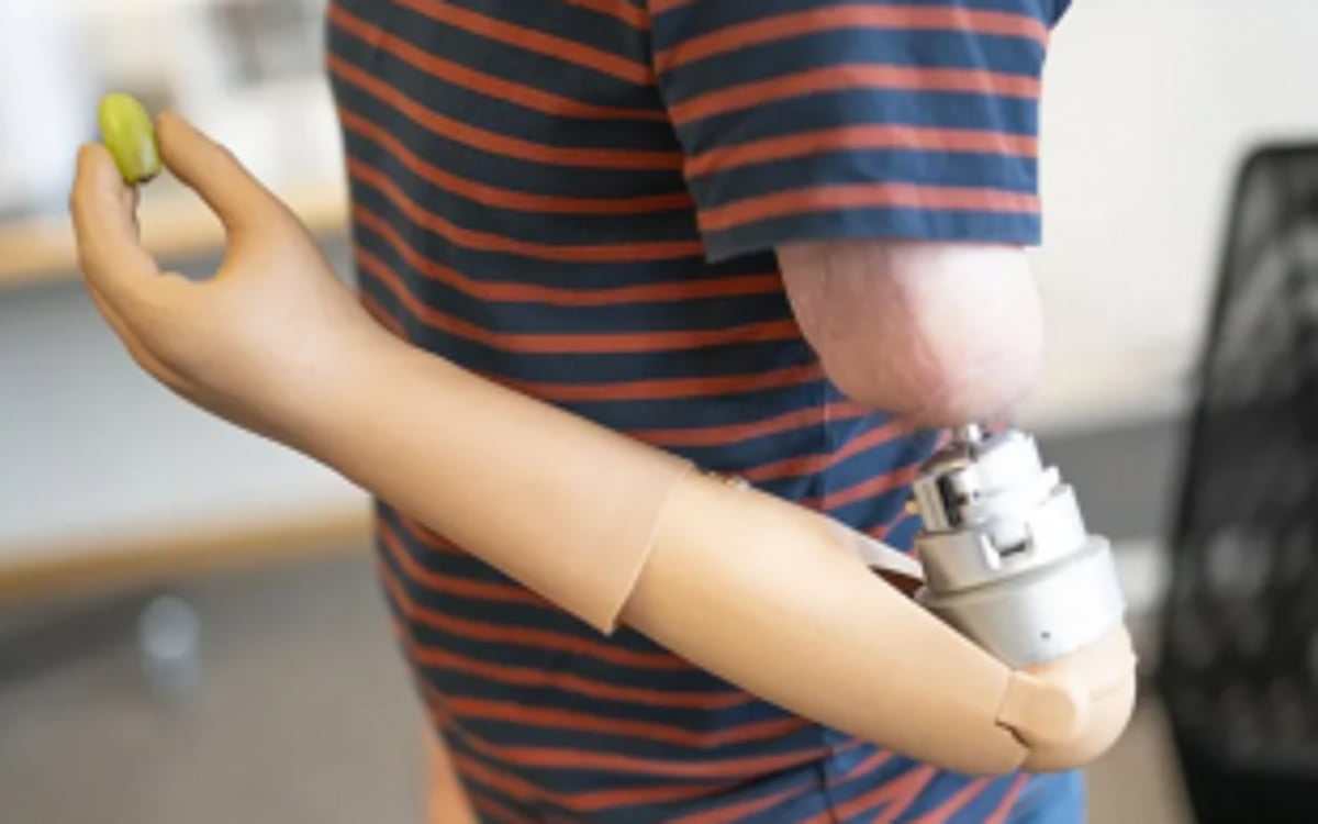 25 PwDs to get latest brain controlled myoelectric  hands free of cost
