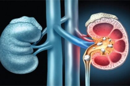 ALL YOU NEED TO KNOW ABOUT KIDNEY STONES