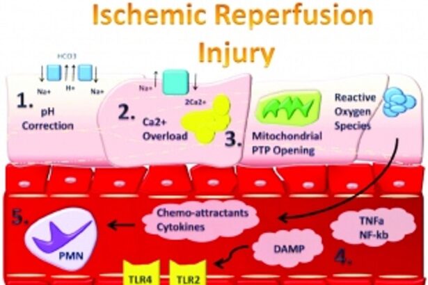 After a heart attack: Decreasing the brunt of reperfusion injury