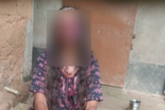 Alcohol-Fueled Assault in Karnataka: Man Bites Off Wife's Eyes and Cheeks in Disturbing Incident