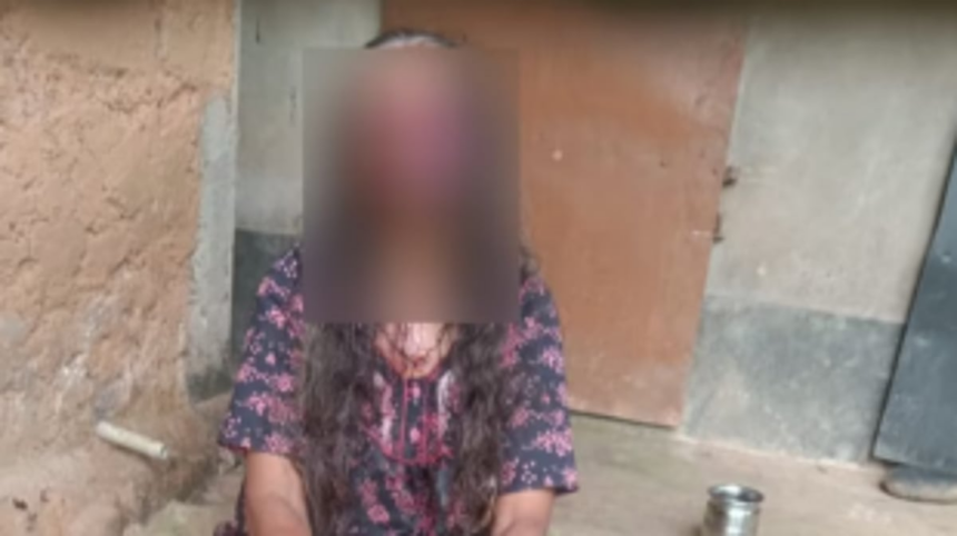 Alcohol-Fueled Assault in Karnataka: Man Bites Off Wife's Eyes and Cheeks in Disturbing Incident