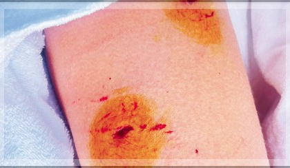 Foreign Tourist Severely Injured in Stray Dog Attack on Mobor Beach