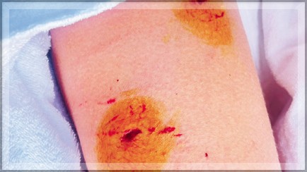 Foreign Tourist Severely Injured in Stray Dog Attack on Mobor Beach