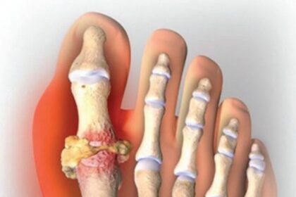 GOUT – GET YOUR FACTS STRAIGHT!