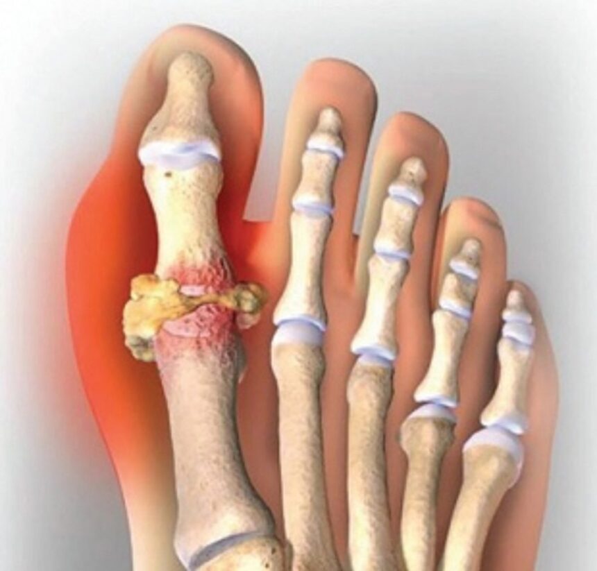 GOUT – GET YOUR FACTS STRAIGHT!