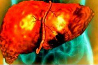 Goa Reports 27 Liver Cirrhosis Deaths Monthly; Surge in Cases Among Middle-Aged Sparks Health Alarm