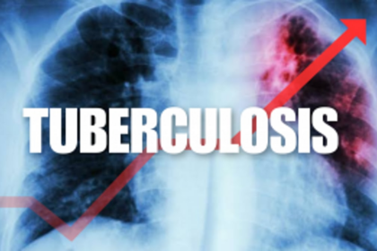 India Tops Global TB Cases in 2022, WHO Report Reveals