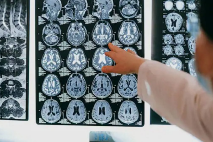 Kerala Reports 61 Brain-Eating Amoeba Cases, 19 Deaths; Health Alert Issued