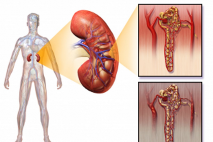 Kidney transplant conducted at Healthway Hospital