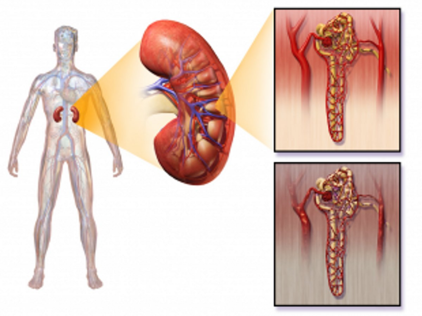 Kidney transplant conducted at Healthway Hospital