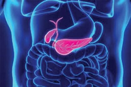 PANCREATIC CANCER IS NOW AN INCREASINGLY COMMON CAUSE OF DEATH