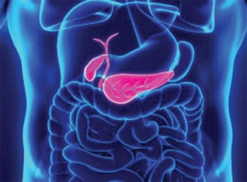 PANCREATIC CANCER IS NOW AN INCREASINGLY COMMON CAUSE OF DEATH