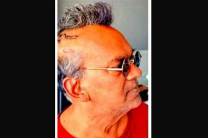 Remo Fernandes Recovers After Burr Hole Surgery, Jokes About ‘Hardcore Punk’ Look