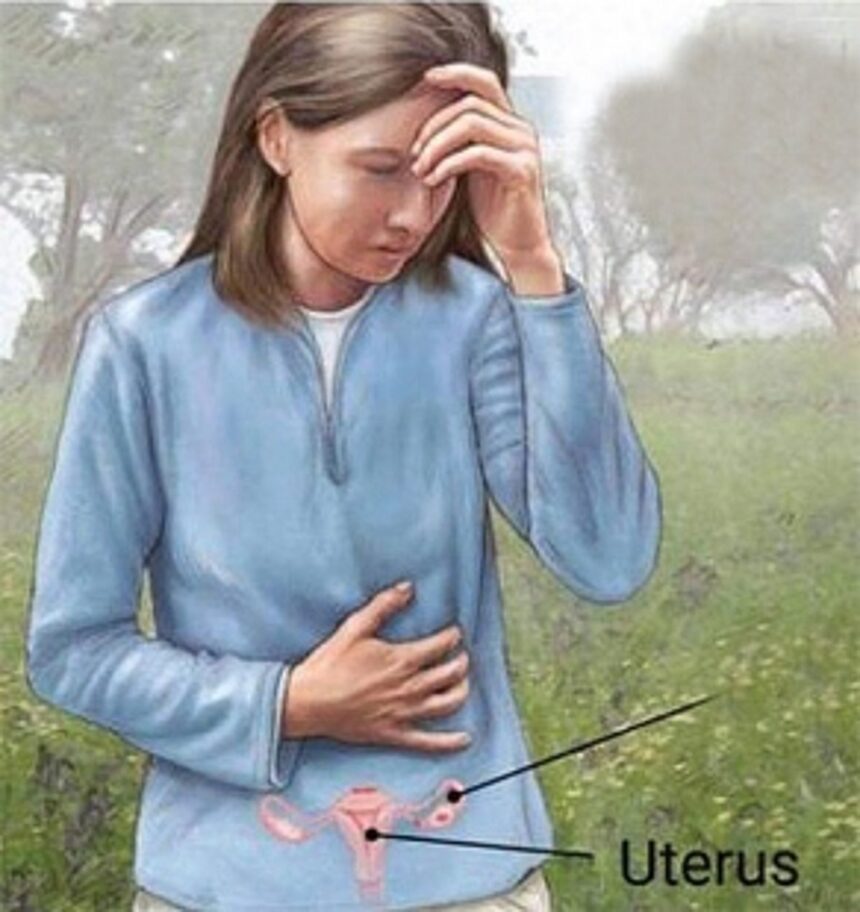 UNDERSTANDING ENDOMETRIOSIS