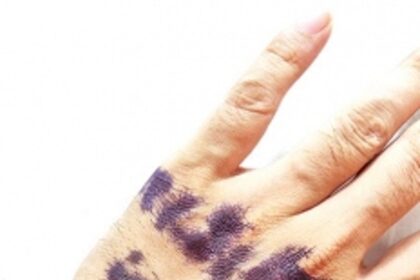 ‘Quarantine’ stamping at Patradevi border checkpost temporarily halted after complaints of skin infections