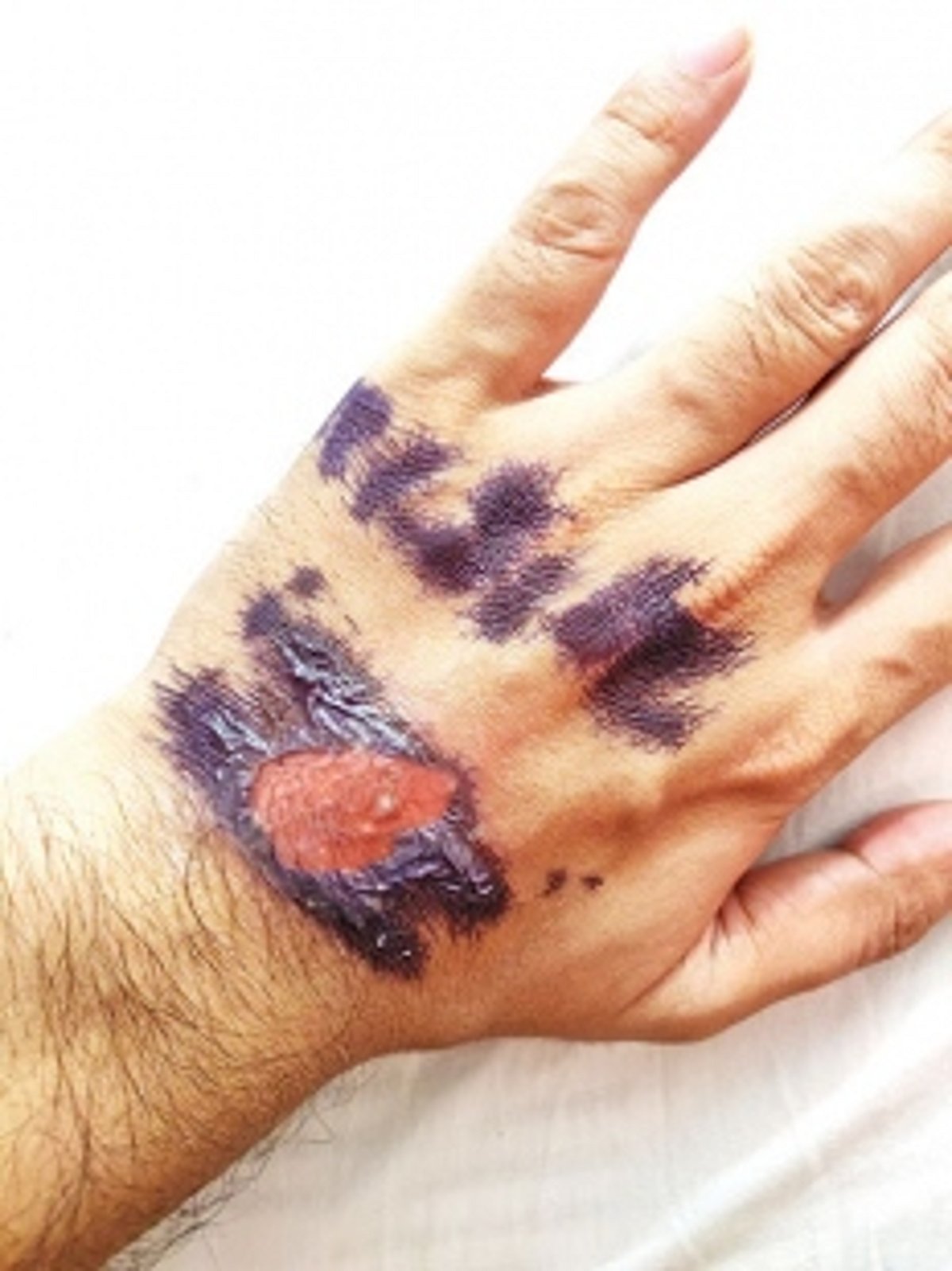 ‘Quarantine’ stamping at Patradevi border checkpost temporarily halted after complaints of skin infections