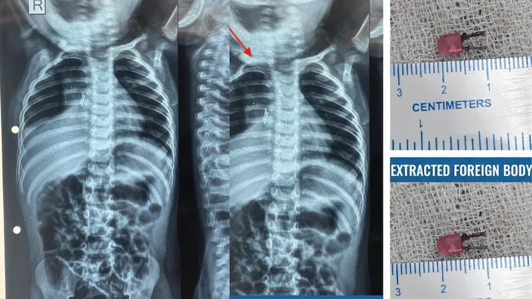 LED Bulb Removed From Gujarat Toddler’s Windpipe After Weeks of Illness 1