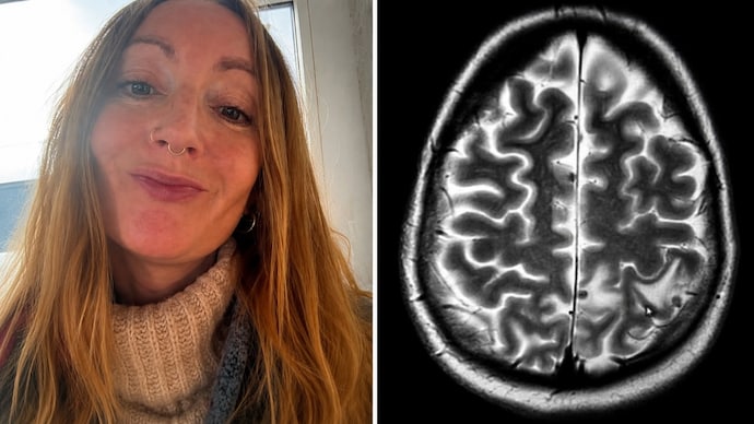 got 38 parasites in brain from india says uk woman 025301213
